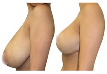 Breast-Reduction